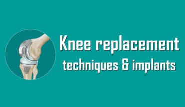 Comprehensive Guide to Knee Replacement Techniques - Infographic