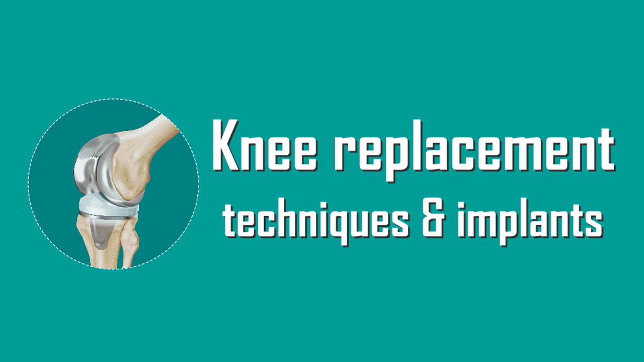 Comprehensive Guide to Knee Replacement Techniques Infographic